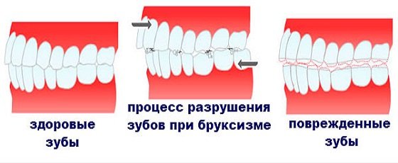 Бруксизм или почему ребенок скрипит зубами?