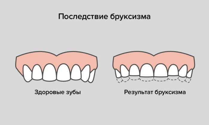 Бруксизм или почему ребенок скрипит зубами?