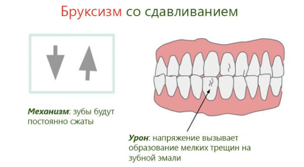 Бруксизм или почему ребенок скрипит зубами?