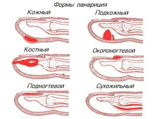 Панариций