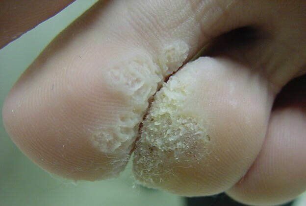 1438429979_wart-1-2-fingae