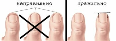 Как обрезать вросший ноготь