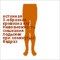 Ноги крестиком Х-образное искривление ног