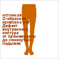 Ноги колесом О-образное искривление ног