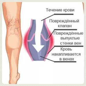 Варикоз признаки