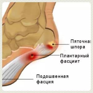 Пяточная шпора лечение