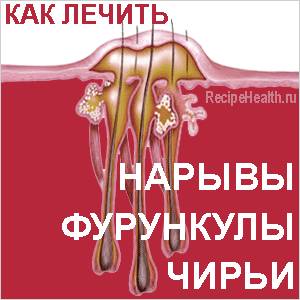 Лечение нарывов, фурункулов, чирьев Как лечить нарывы и чирьи