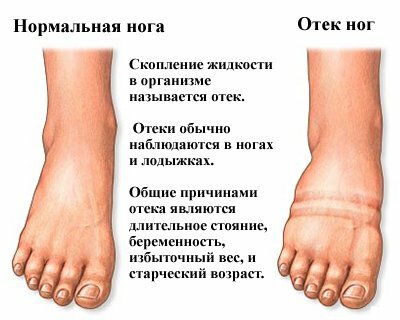 Мочегонные средства при отеках ног – что поможет?