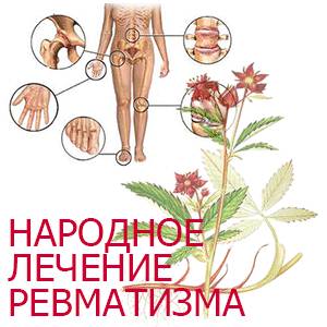 Как лечить ревматизм О лечении ревматизма