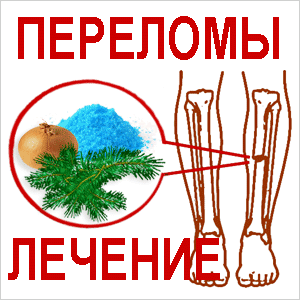 Перелом Лечение переломов