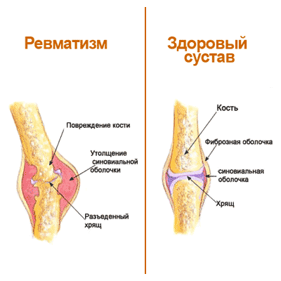 Ревматизм схематично ревматизм