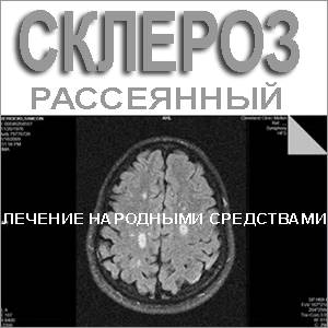Склероз на МРТ Томография мозга - склероз