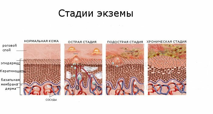 Экзема и ее проявления, лечение болезни