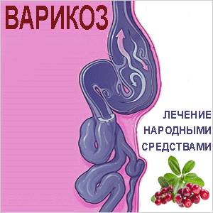 Как лечить варикоз Лечение варикоза